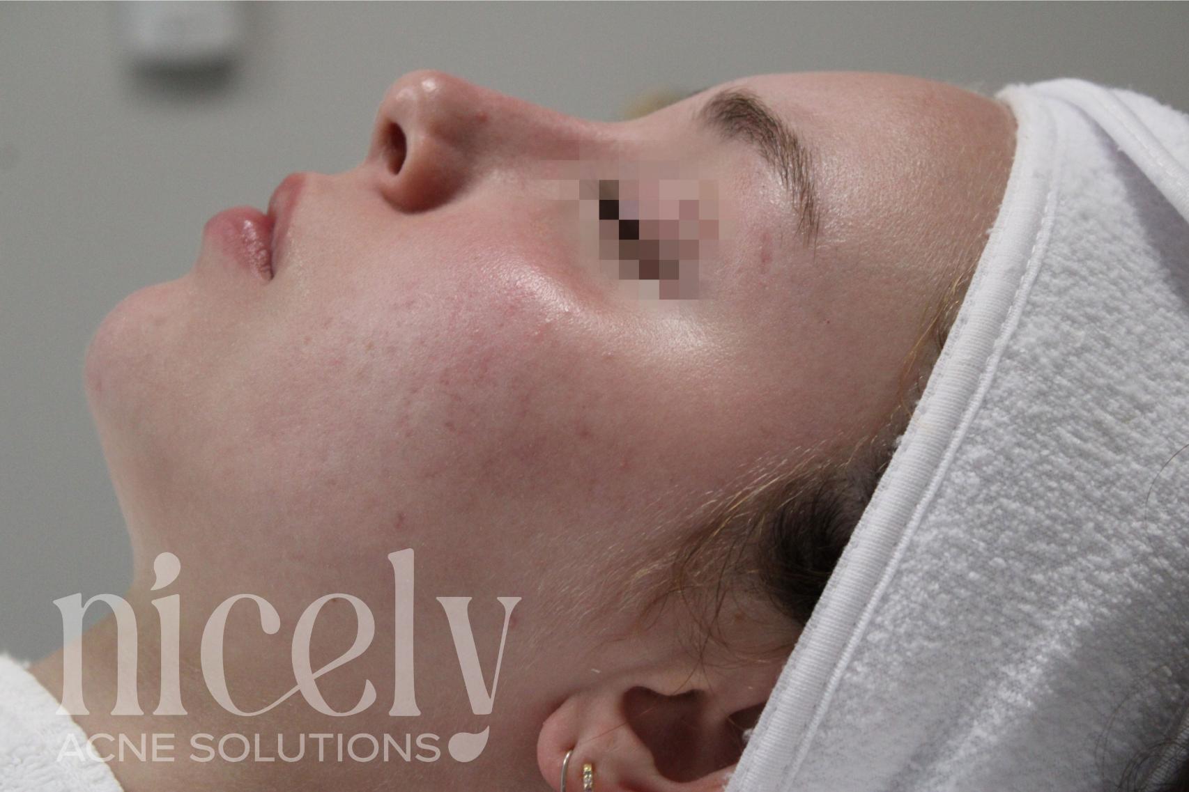 After: After treatment