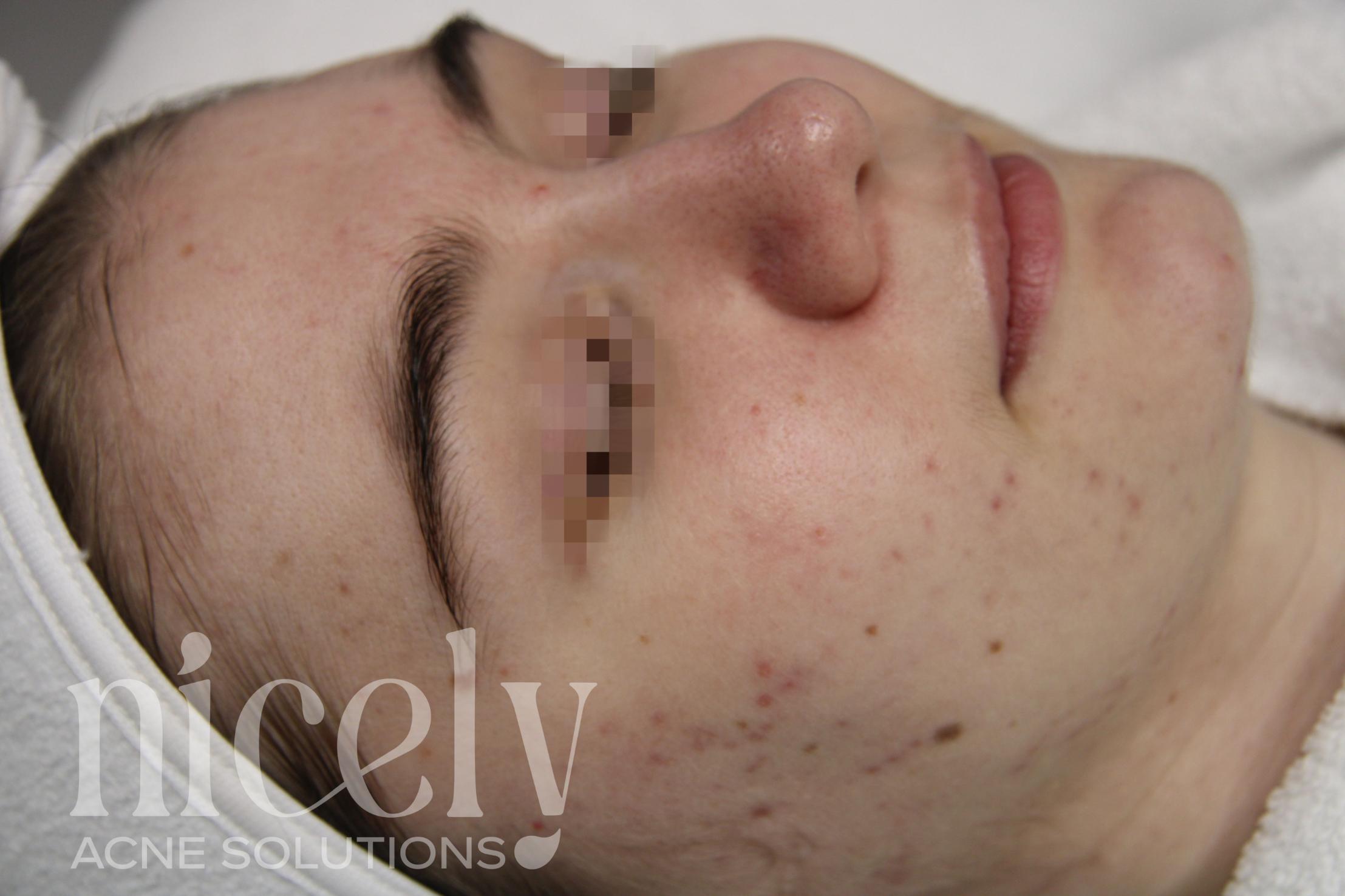 Before: Before treatment