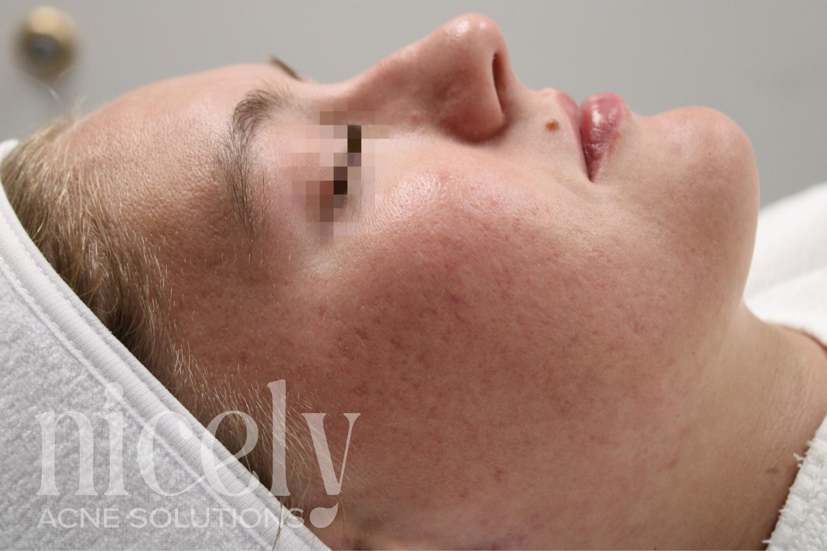 After: After treatment